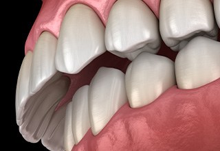 Illustration of an overbite