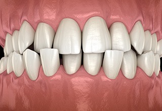 Illustration of a crossbite