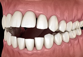 Illustration of an open bite