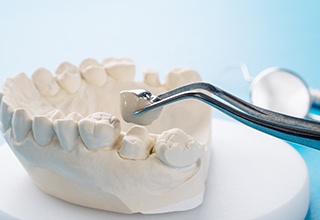 Dental crown being placed on clay model