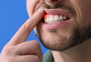 Close up of bearded man with gum disease