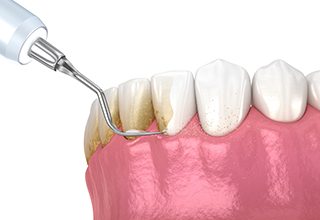 Illustration of scaling being performed on lower teeth