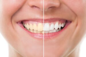 Nose-to-chin frontal view of a woman smiling with half her teeth whitened