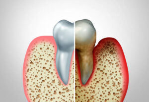 Periodontal pocket compared to healthy gums