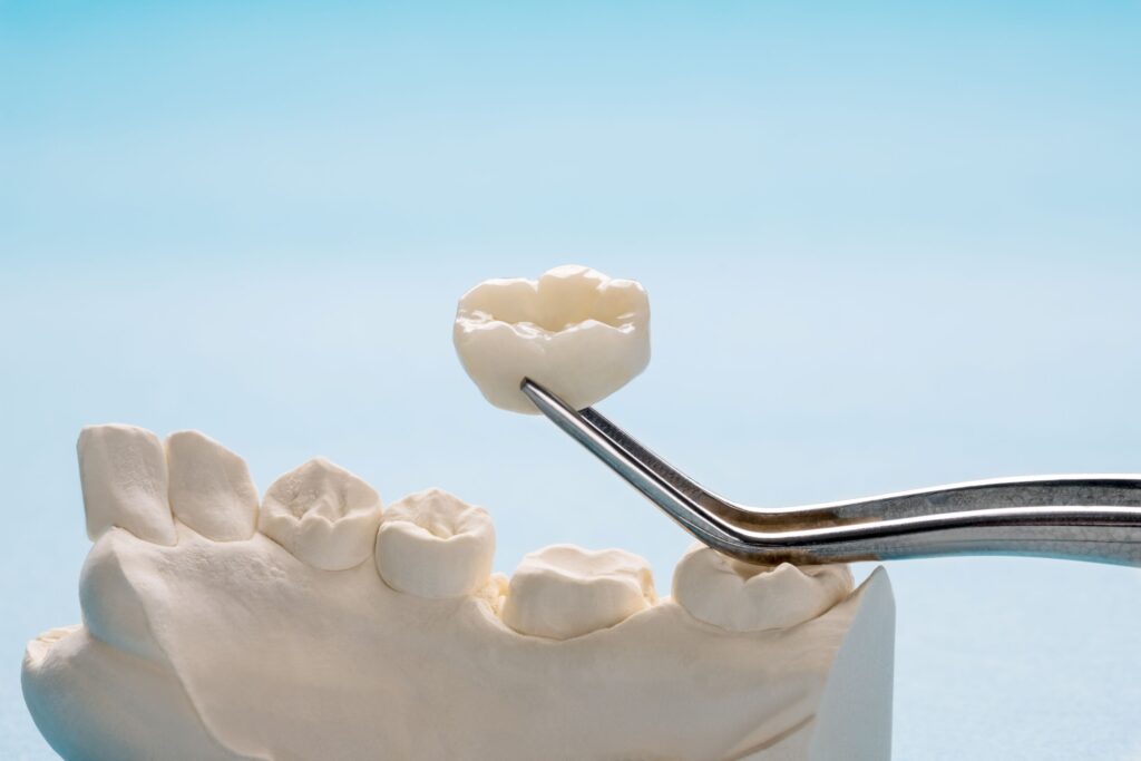 Dental crown being placed over cast of teeth with light blue background